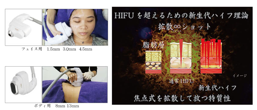 ultimation hifu product